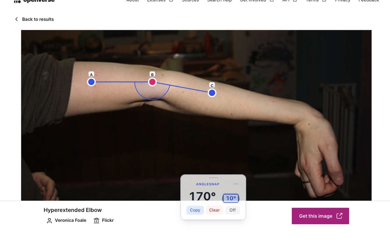 AngleSnap measuring wrist extension during a telehealth visit — 68° reading